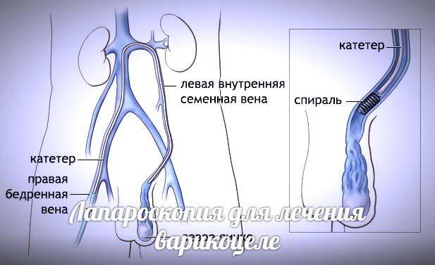 операция варикоцеле лапароскопия