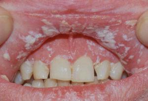 pseudomembranous-candidiasis-on-gingiva-gums-lips-300x206.jpg
