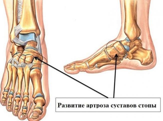 artroz_stopy_vozmut_armiyu.jpg
