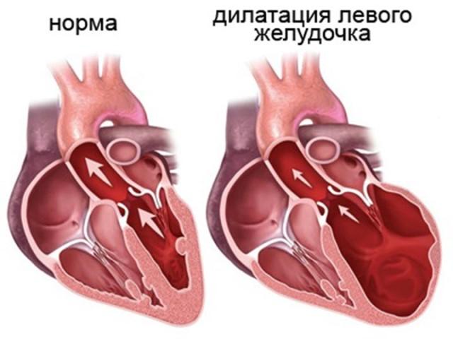 dilataciya-levogo-zheludochka.jpg