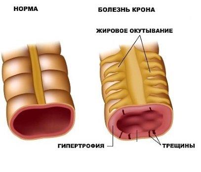 videogastroduodenoskopiya-novejshij-metod-obsledovaniya-pishchevaritelnogo-trakta-5.jpg