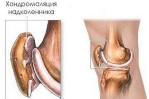 hondromalyatsiya-nadkolennika-opisanie-bolezni-i-simptomatika1-300x200.jpg