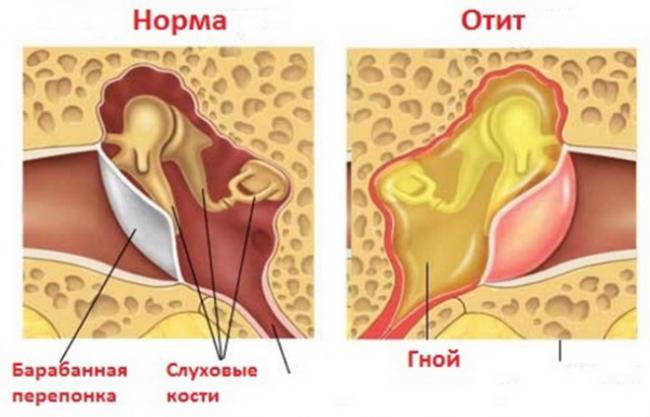 kak-lechit-otit-v-domashnih-usloviyah3.jpg