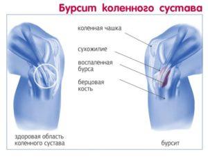 gemorragicheskiy-bursit-kolennogo-sustava-300x227.jpg
