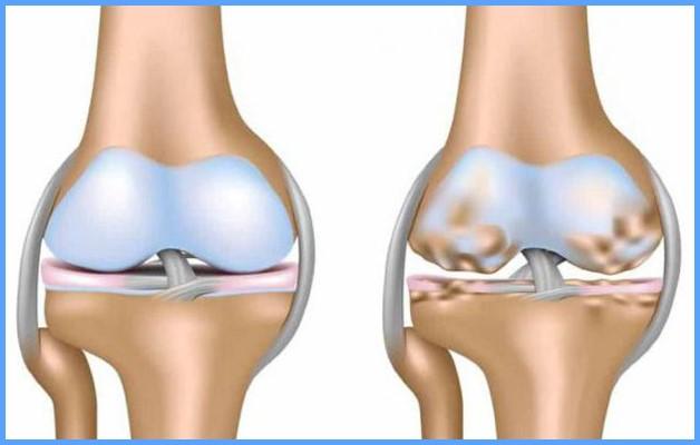 osteohondropatiya-kolena2.jpg