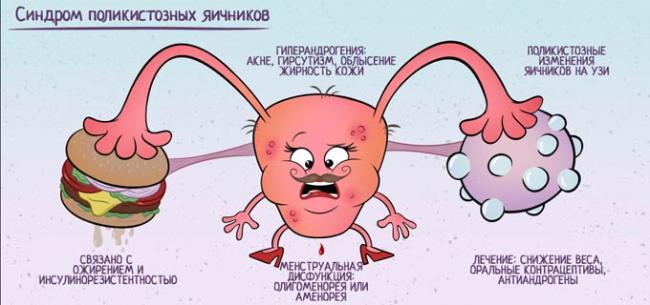 синдром поликистозных яичников