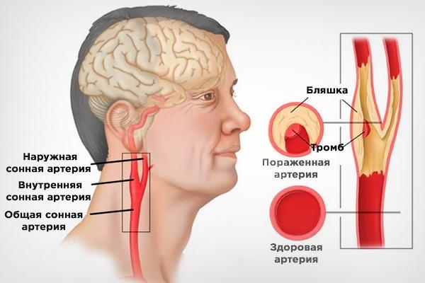 zakuporka-sonnoj-arterii.jpg