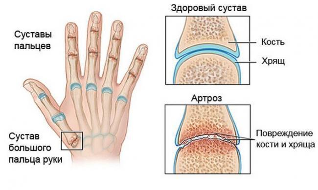 artroz-sustavov-palcev-ruk.jpg