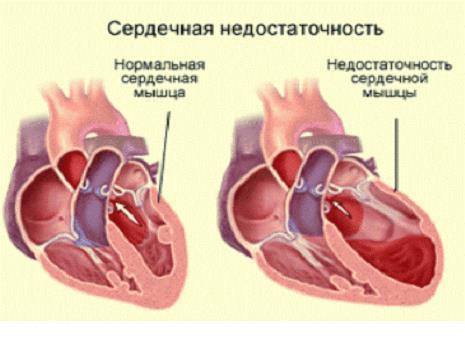 Сердечная-недостаточность.jpg