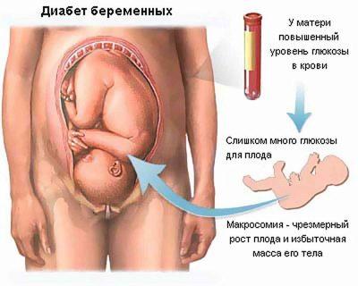 prichiny-i-posledstviya-povyshennogo-sahara-v-krovi-pri-beremennosti-3.jpg
