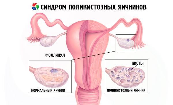 нормальный и поликостозный яичник