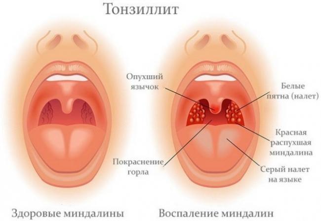 Priznaki-tonzillita-1-e1520825695217-670x463.jpg