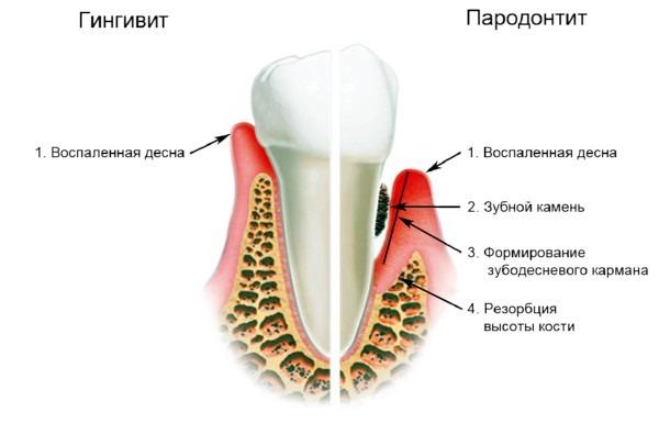 chto-mozhet-vyzyvat-bol-v-grudnoy-kletke-pri-glotanii-3.jpg