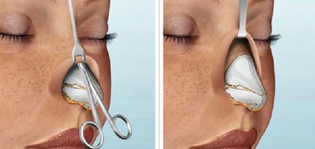 hod-rinoplastiki.jpg