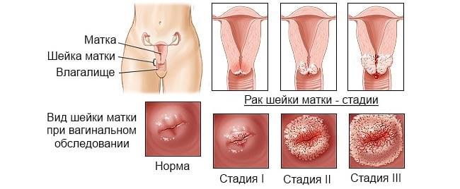 стадии рака шейки матки