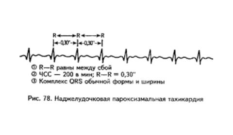 tachikardij_paroksizmalnaj_ekg.png