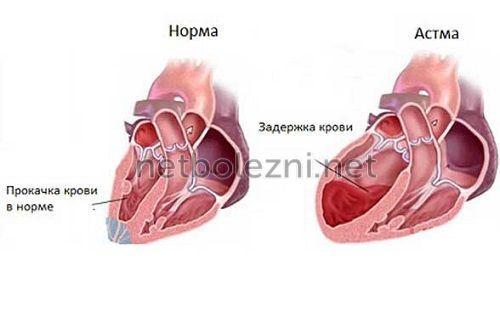 1500020501_proyavlenie-serdechnoy-astmy.jpg