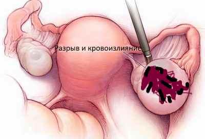 razryv-kisty-yaichnika.jpg