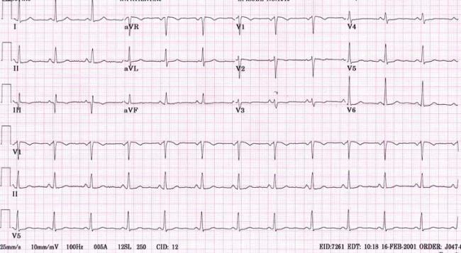 normalnaja-ekg.jpg