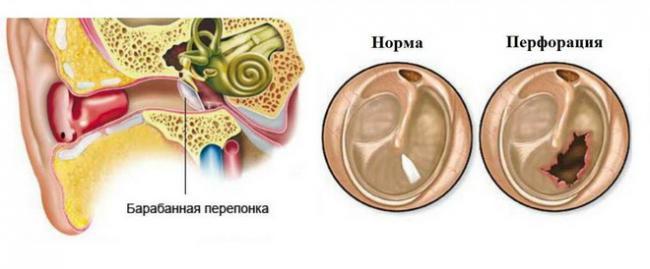 operaciya-po-vosstanovleniyu-barabannoy-pereponki3.jpg