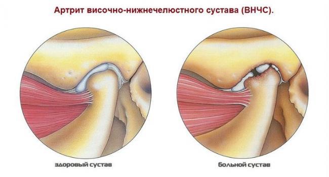 Artrit-visochno-nizhnechelyustnogo-sustava.jpg