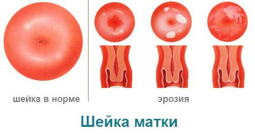 shejka-matki-eroziya.jpg