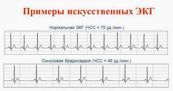 sinusovaya-bradikardiya2.jpg