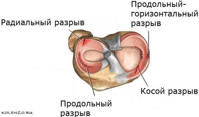 pod-kolennoj-chashechkoj-bolit.jpg