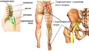 Защемление-седалищного-нерва-300x173.png
