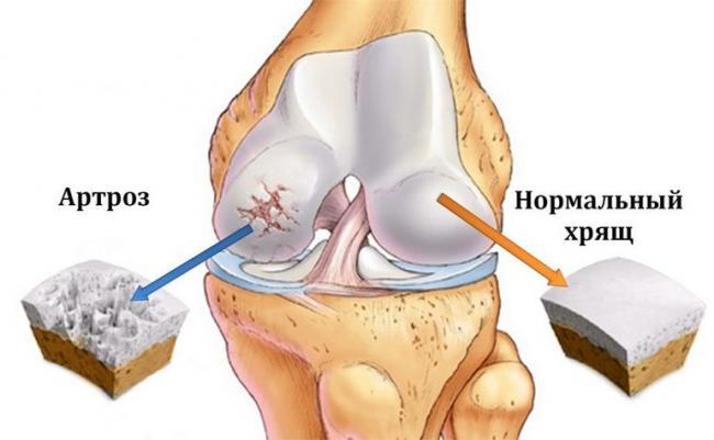 osnovnye_simptomy_artroza.jpg
