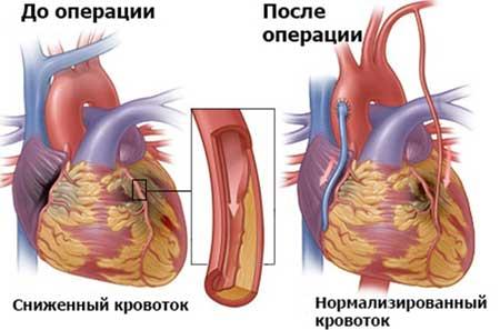 shuntirovanie-sosudov-serdca.jpg