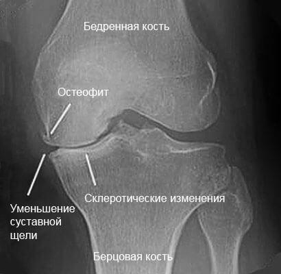 sujenie_sustavnoi_sheli.jpg
