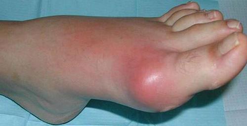 simptomyilechenievirusnogoartrita3.jpg