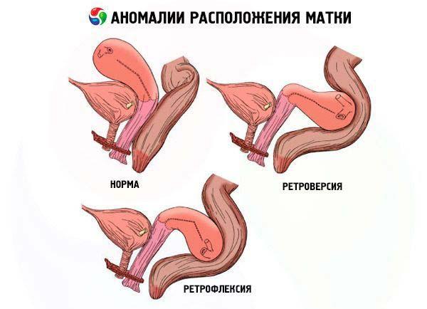 аномалии расположения матки