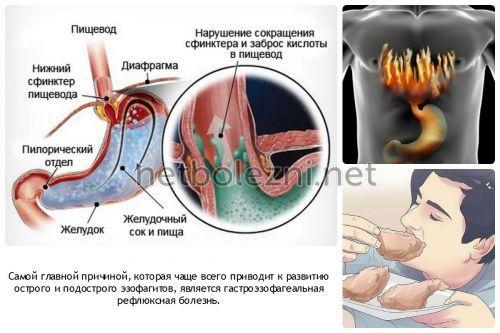 1497604129_prichiny-vozniknoveniya-reflyuksa.jpg