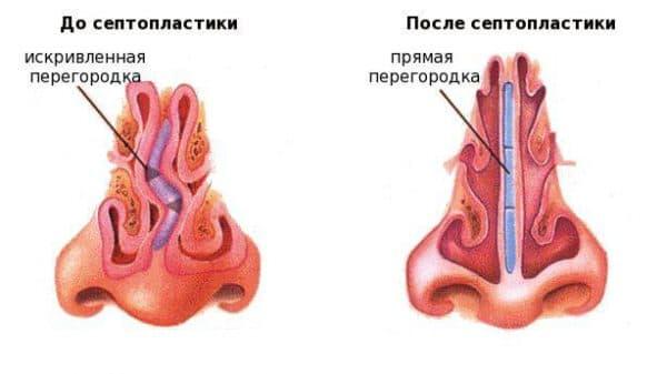 %D0%A1%D0%B5%D0%BD%D0%BE%D0%BF%D0%BB%D0%B0%D1%81%D1%82%D0%B8%D0%BA%D0%B0-%D0%BB%D0%B0%D0%B7%D0%B5%D1%80%D0%BD%D0%B0%D1%8F-%D0%BA%D0%BE%D1%80%D1%80%D0%B5%D0%BA%D1%86%D0%B8%D1%8F-%D0%BD%D0%BE%D1%81%D0%BE%D0%B2%D0%BE%D0%B9-%D0%BF%D0%B5%D1%80%D0%B5%D0%B3%D0%BE%D1%80%D0%BE%D0%B4%D0%BA%D0%B8-600x337.jpg