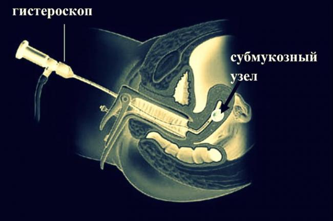 показания для гистероскопии