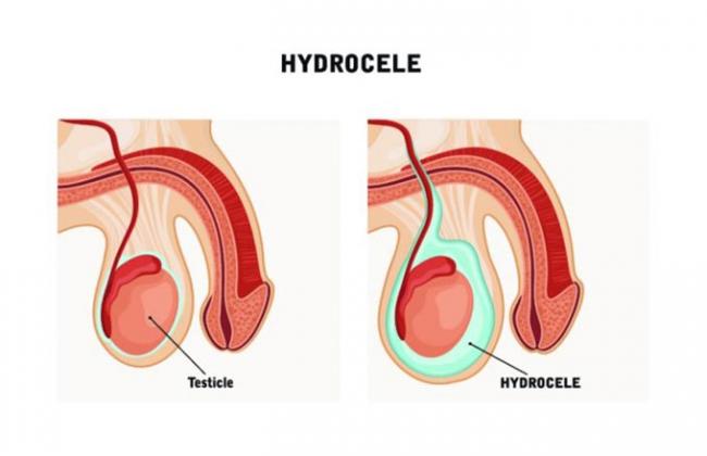 hydrocele