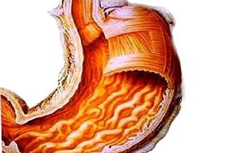 gemoragicheskii-gastrit5.jpg