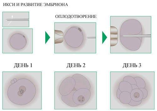 этапы икси