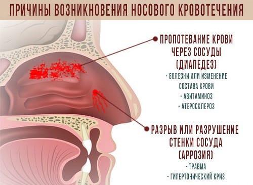 prichiny-nosovogo-krovotecheniya.jpg