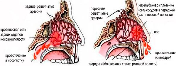 osnovnyeprichinychastykhkrovotecheniyiznosa1.jpg