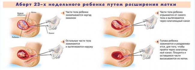 схема проведения аборта