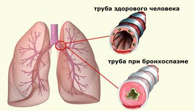 bronhospazm2.jpg