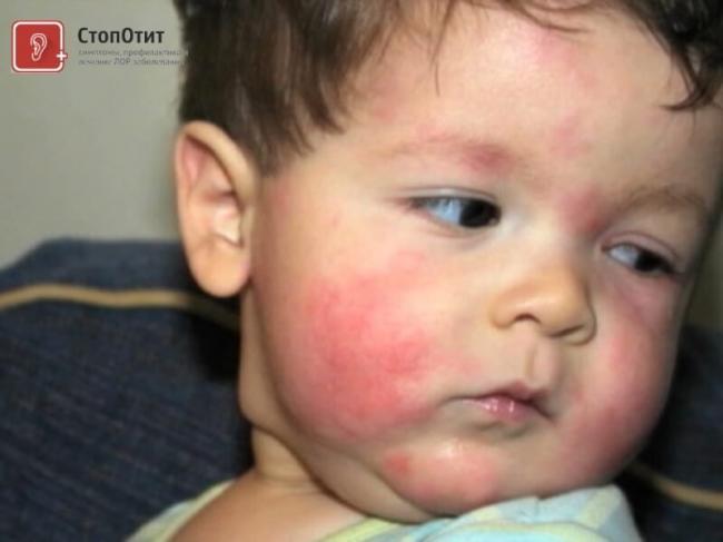 allergiya-med-rebenok.jpg