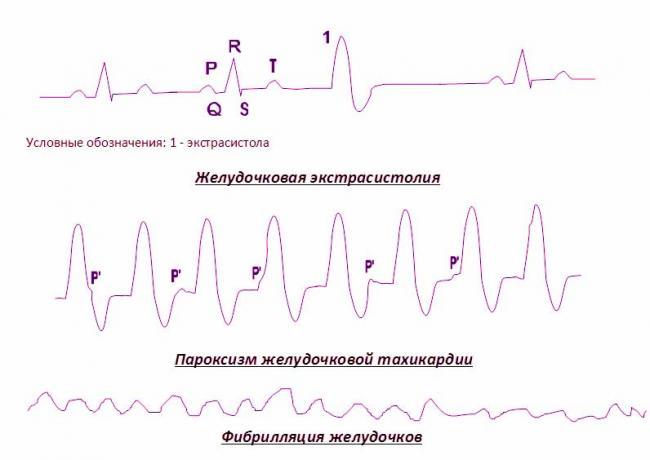 zheludochkovaya-ehkstrasistoliya_3.jpg