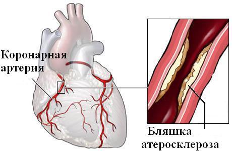 prosvete-koronarnyih-sosudov.jpg