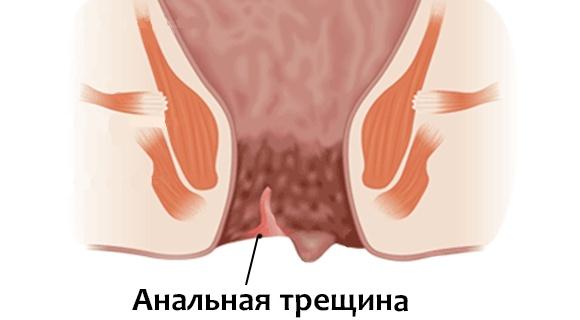 analnaya-treshina.jpg