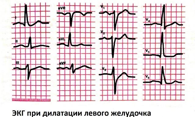 dilataciya-serdca-ekg.jpg