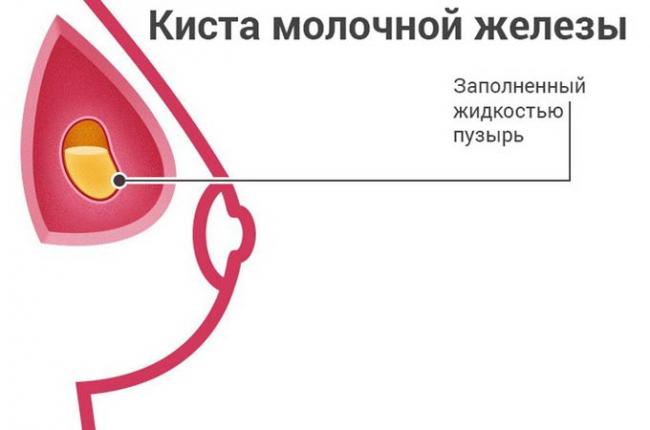 киста в груди